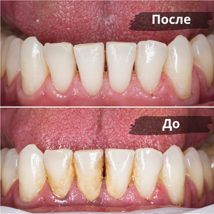 Bylo-stalo-posle-chistki-zubov