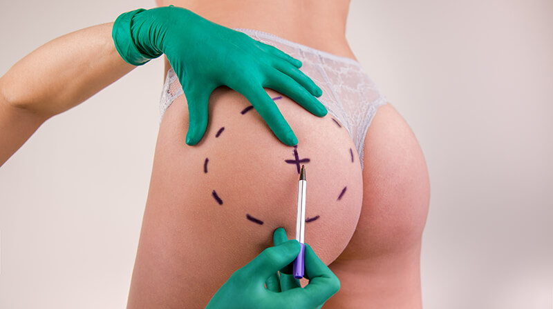 buttlift