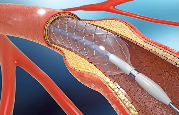 STENTING