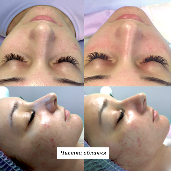 rezultati_chistka_oblichchya_1
