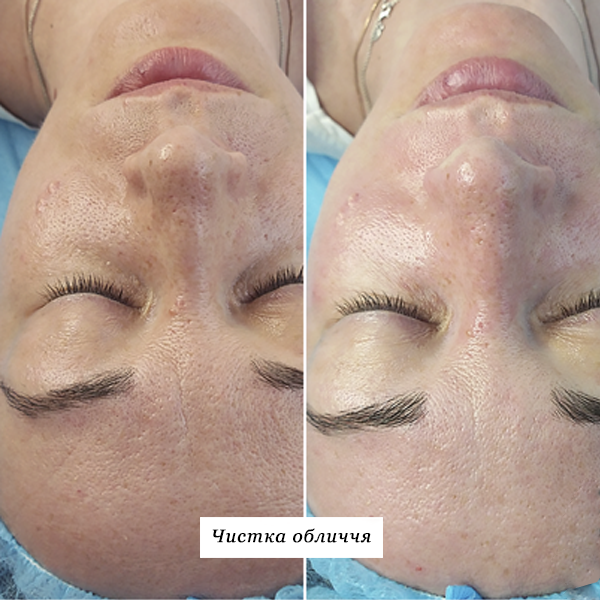 rezultati_chistka_oblichchya_5