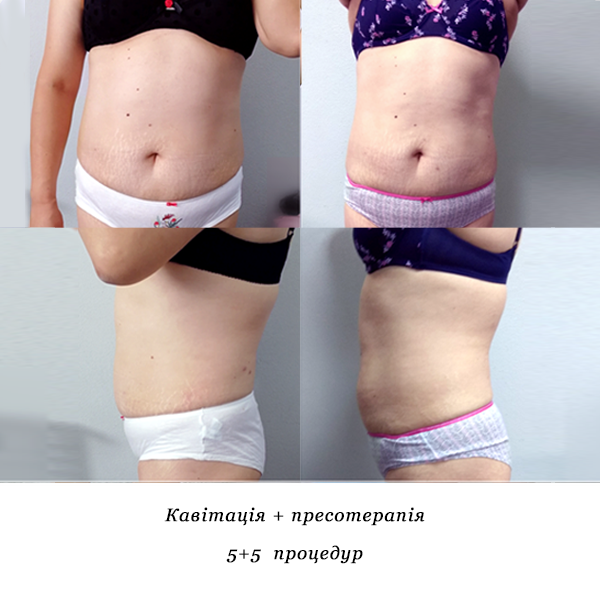 rezultati_kavitatsiya_presoterapiya_9