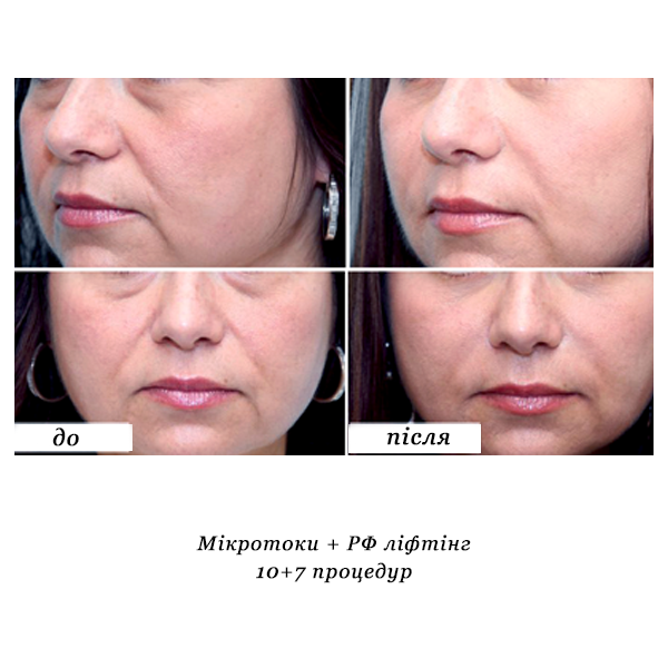 rezultati_mikrotoki_rf_lifting_4