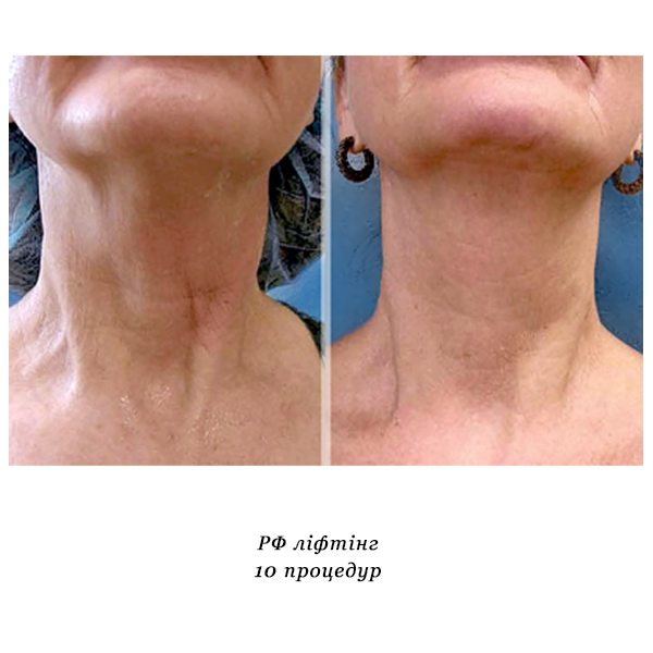 rezultati_rf_lifting_oblichchya_2