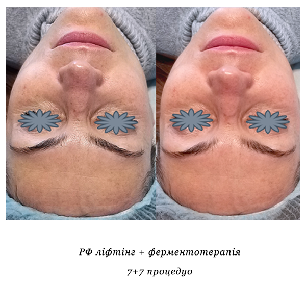 rezultati_rf_lifting_piling_7