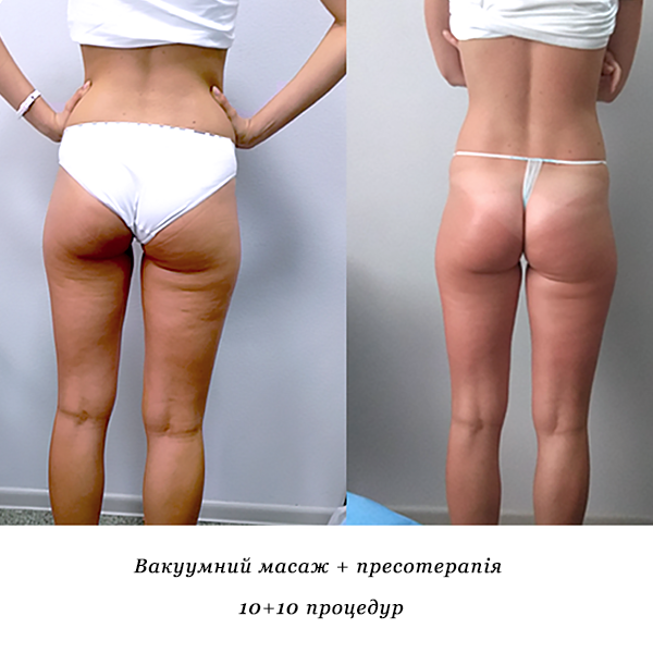 rezultati_vakuumniy_masazh_presoterapiya_1