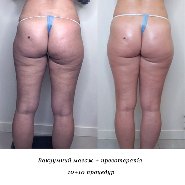 rezultati_vakuumniy_masazh_presoterapiya_2