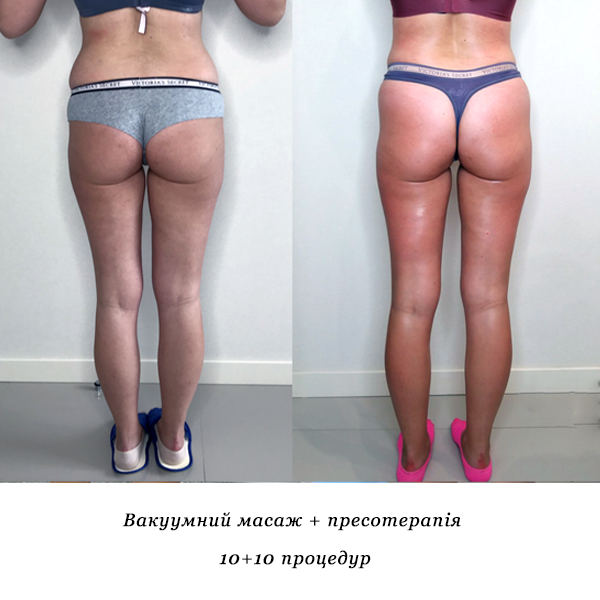 rezultati_vakuumniy_masazh_presoterapiya_3