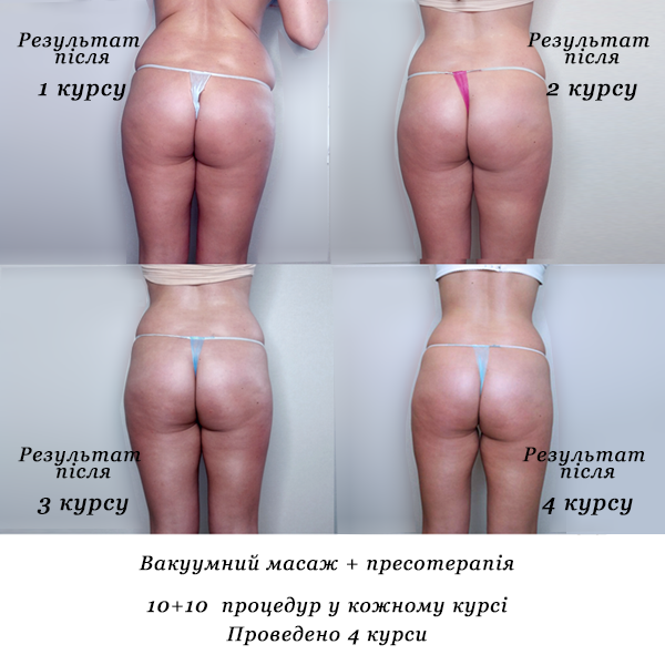 rezultati_vakuumniy_masazh_presoterapiya_4_kursi_protsedur_10