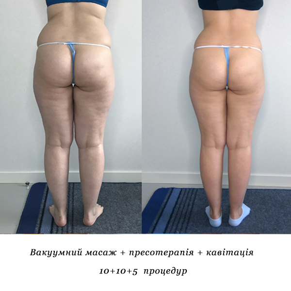 rezultati_vakuumniy_masazh_presoterapiya_kavitatsiya_6