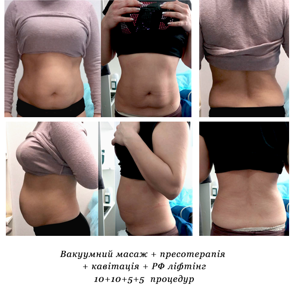 rezultati_vakuumniy_masazh_presoterapiya_kavitatsiya_rf_lifting_7