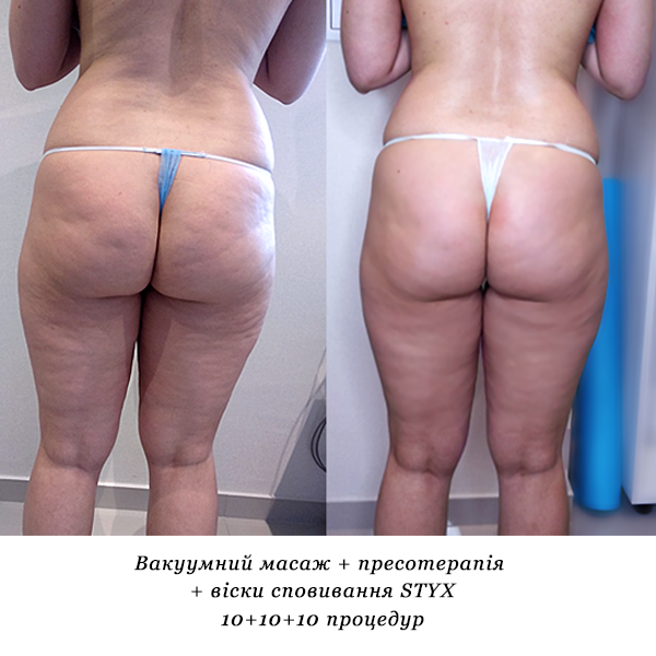 rezultati_vakuumniy_masazh_presoterapiya_viski_spovivannya_STYX_4