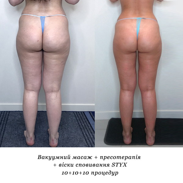 rezultati_vakuumniy_masazh_presoterapiya_viski_spovivannya_STYX_5