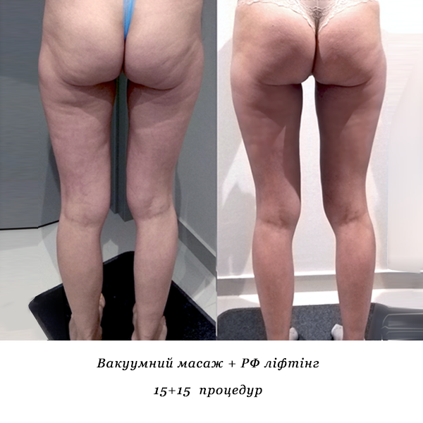 rezultati_vakuumniy_masazh_rf_lifting_8