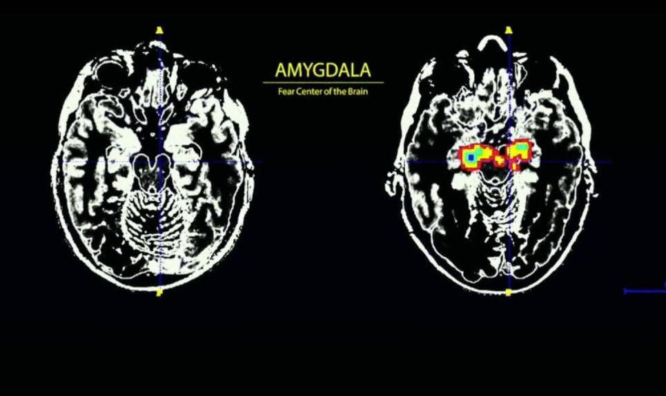 amigdala