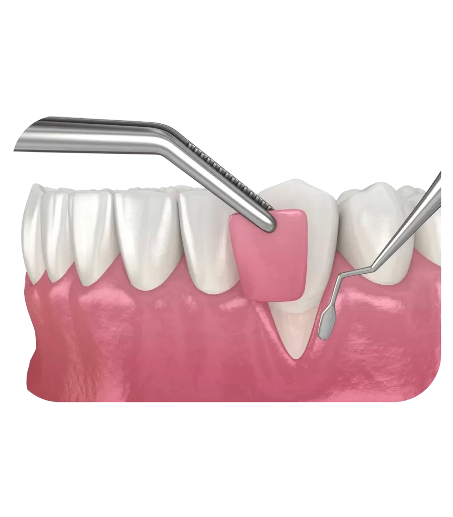 Likuvannya-retsesiyi-yasen-898x1024